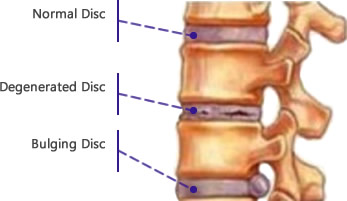 spinal disc pathology